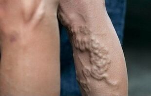 Varicose veins sa mga bitiis