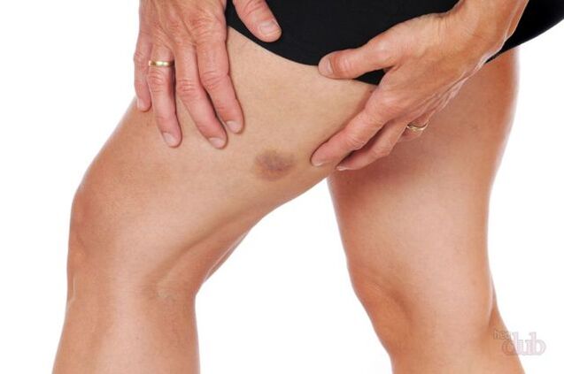 Kung ang usa ka vursts sa ugat