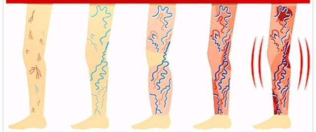 Unsa ang Dili Buhaton sa Varicose Veins