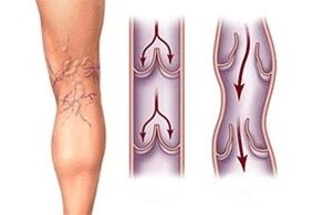 Pag-agos sa dugo sa varicose veins sa lainlaing mga yugto sa pag-uswag sa sakit