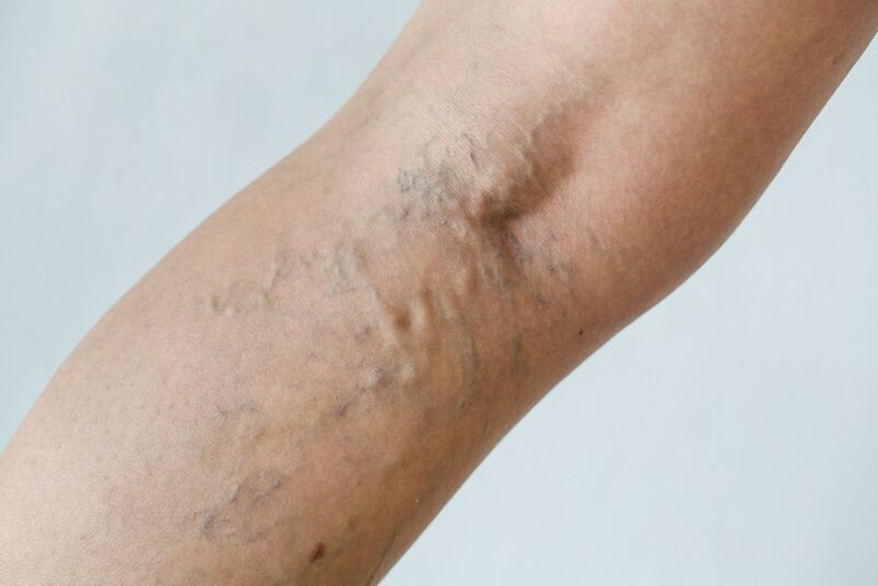 Stage C2 - popliteal varicose veins (Thierry perforator) ug reticular veins